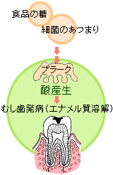 虫歯の発病の原因