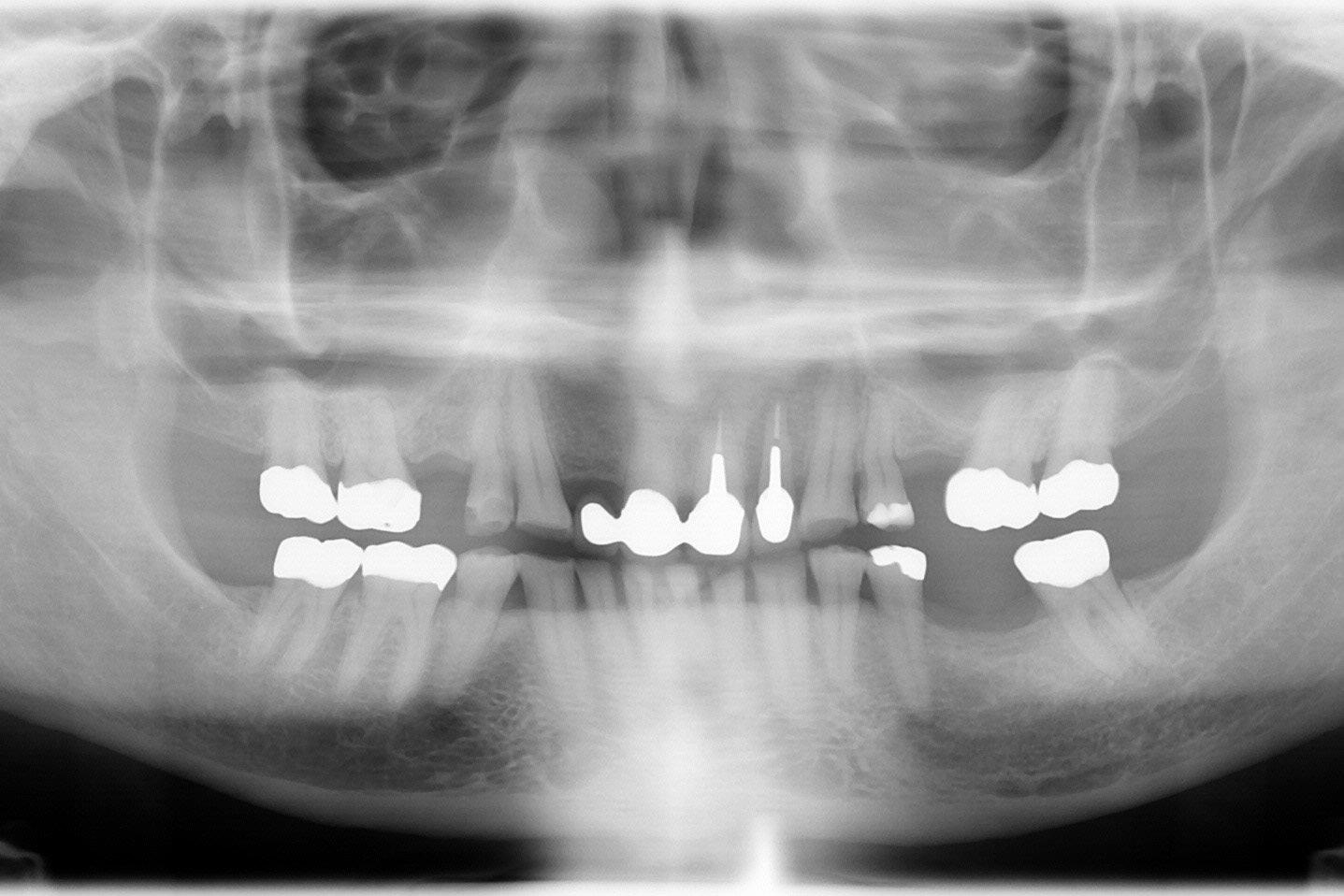 被せ物の治療前X線