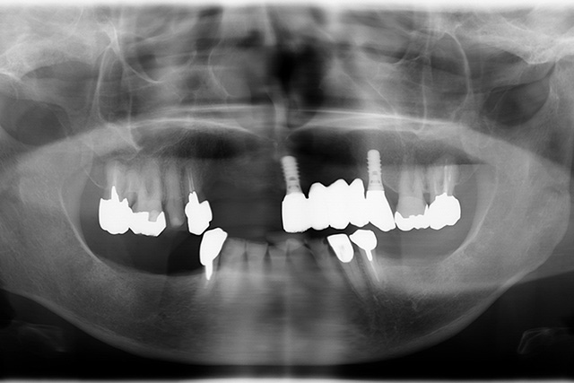 インプラント治療前X線