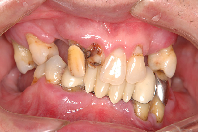 インプラント＋義歯治療前