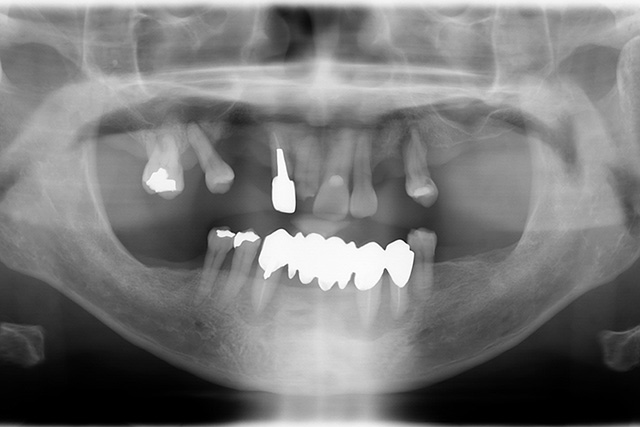 インプラント＋義歯治療前X線