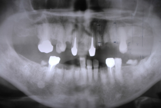 インプラント治療前X線