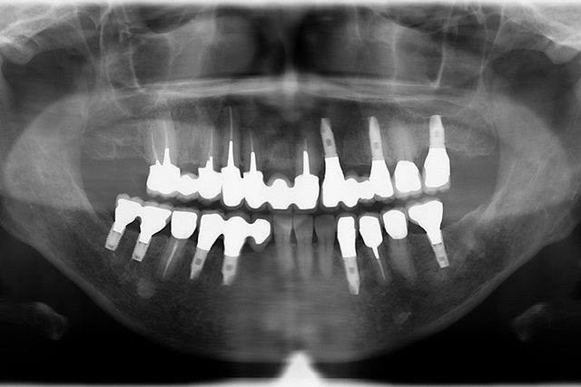 インプラント治療後X線