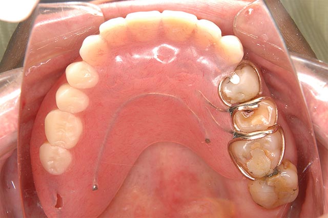 上あご（義歯あり）